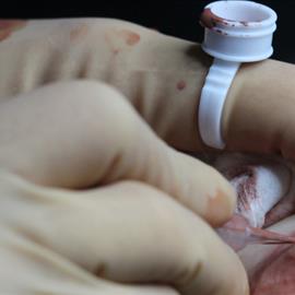 Micropigmentación mamaria para pacientes oncológicas