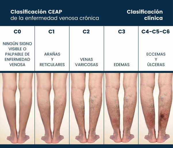 Heel España - Uno de los motivos principales del síndrome de las piernas  cansadas es la insuficiencia venosa, que provoca que las venas de las  piernas presenten cierta dificultad a la hora