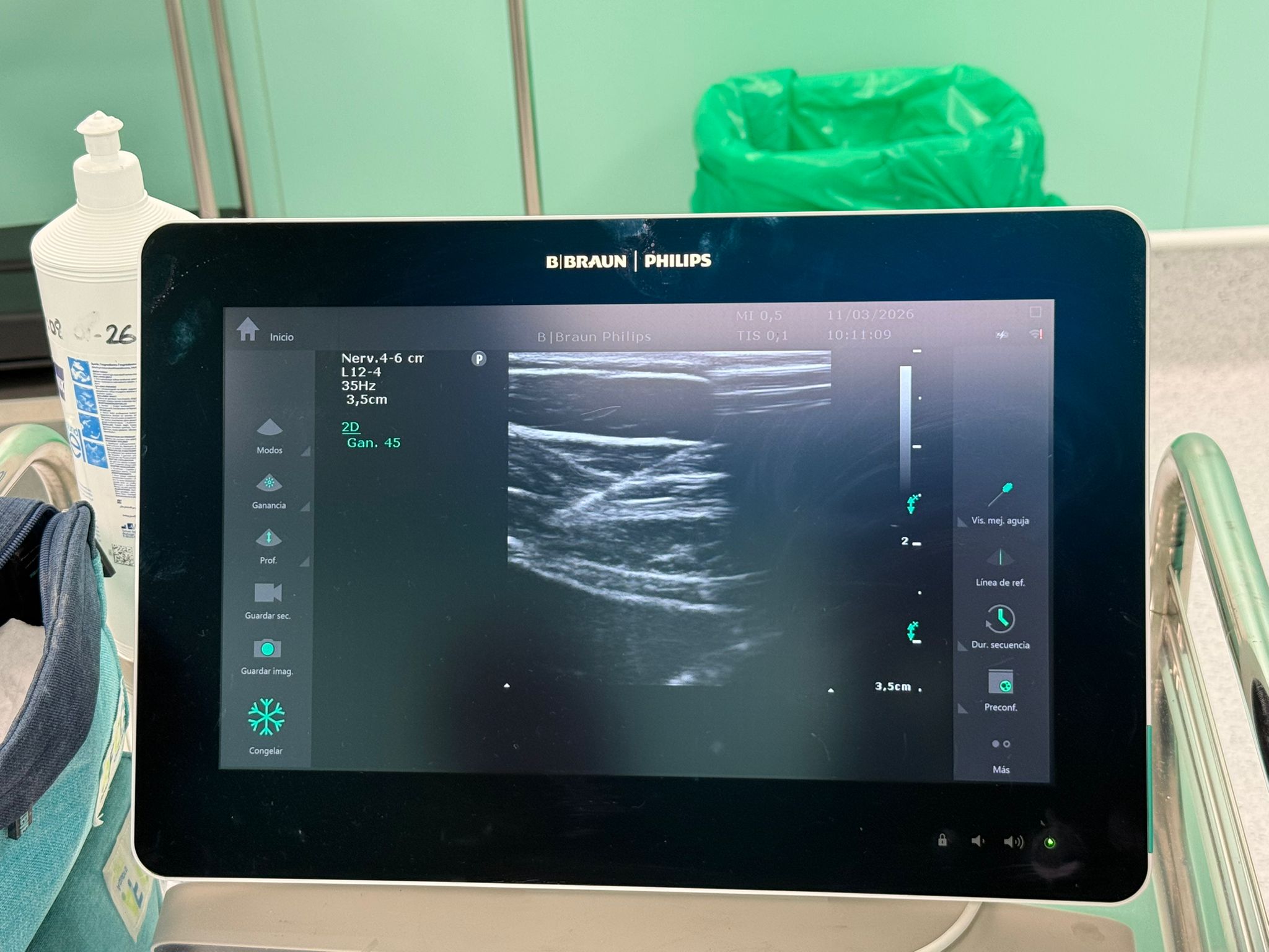 Ecografía Toxina botulínica