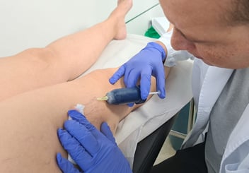 Crioesclerosis: luce una piernas bonitas y libres de arañas vasculares