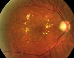 Retinografía edema macular