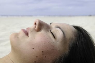 Reconoce un melanoma, la importancia de la detección precoz