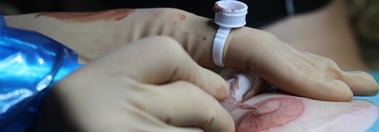 Micropigmentación mamaria para pacientes oncológicas