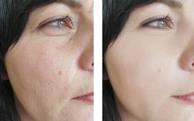 Profhilo: La revolución en medicina estética para una piel radiante