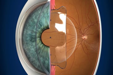 Descubre las lentes ICL. Visión mejorada sin limitaciones