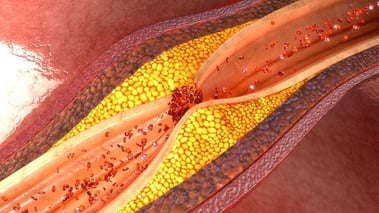 ¿Qué es la ateromatosis?