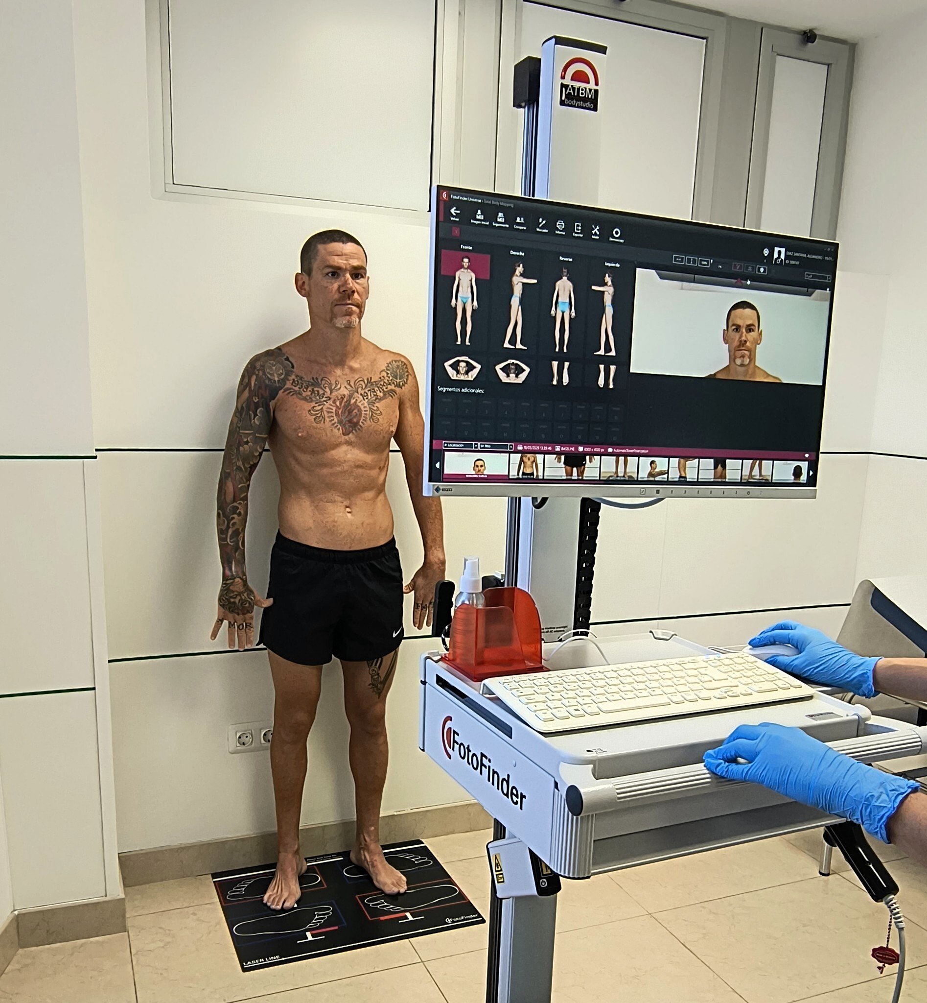 FotoFinder Body Scan_Seguimiento de lunares_dermatitis_psoriasis_melanoma_Hospiten Roca