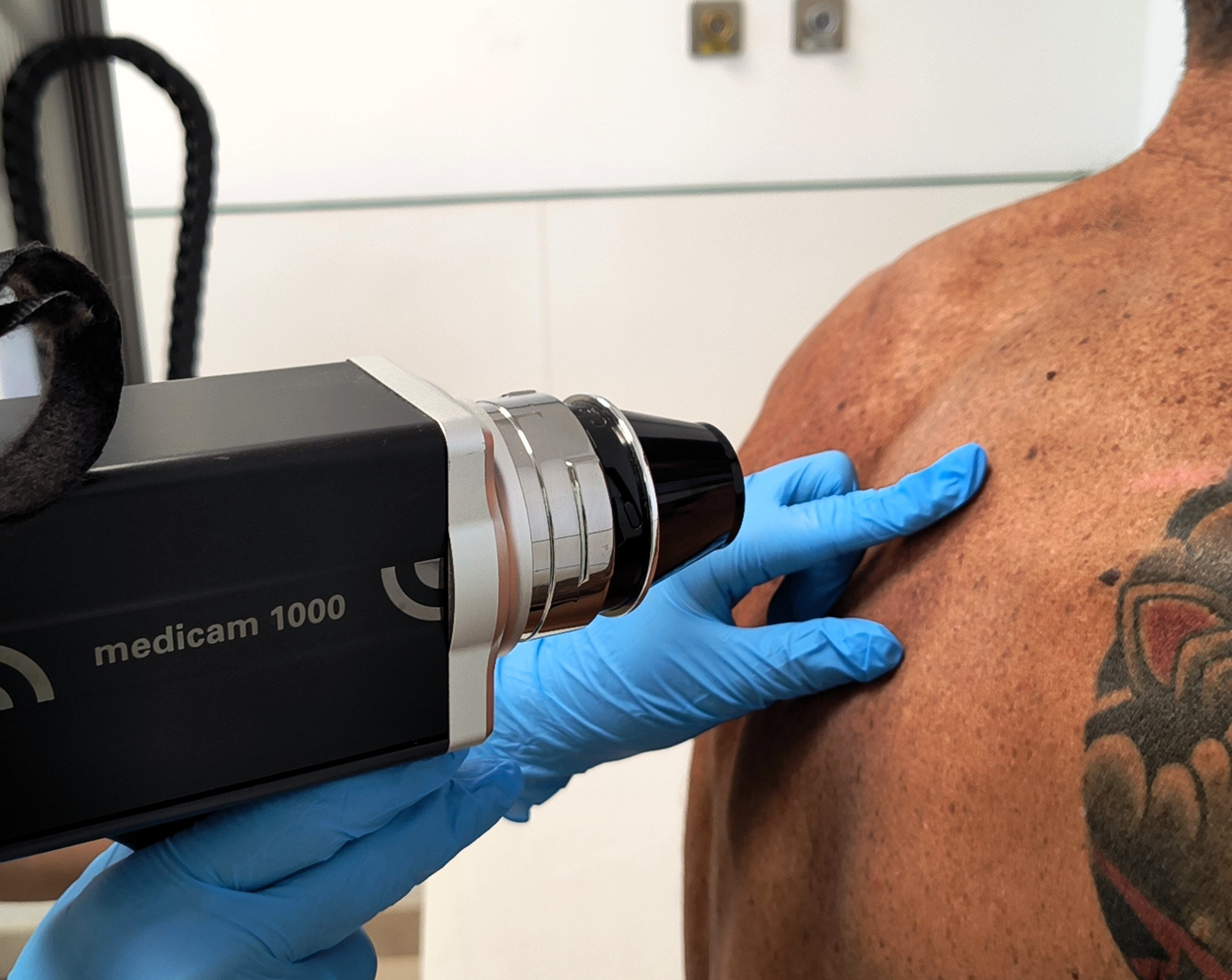 FotoFinder BodyScan_Seguimiento de lunares_ Dermatitis_psoriasis_melanoma_Hospiten Roca