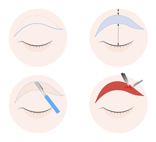 blefaroplastia_cirugía_parpadocaido_hospitenroca_maspalomas_sanbartolomedetirajana
