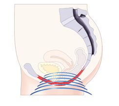 tratamiento_avanzado_para_la_i_5841cf38