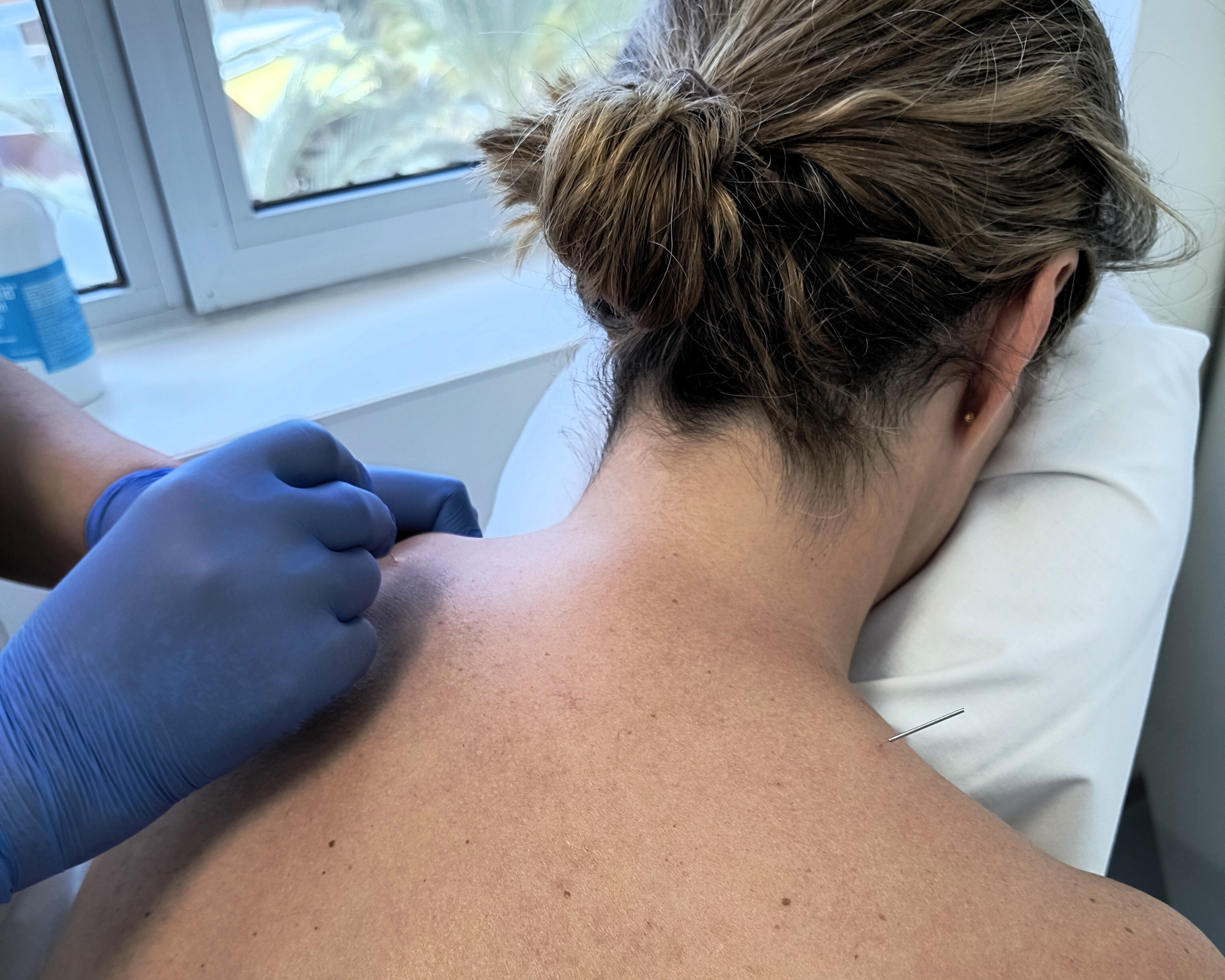 fisioterapia_Hospiten_Roca_Punción_seca