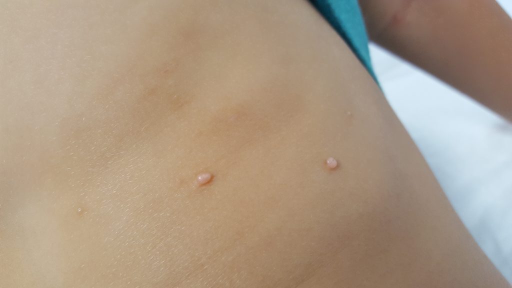 Moluscos contagiosos: este verano evita que tus hijos se contagien en la piscina 