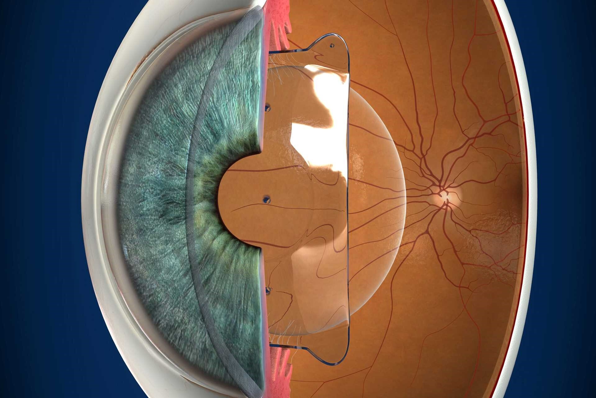 Descubre las lentes ICL. Visión mejorada sin limitaciones
