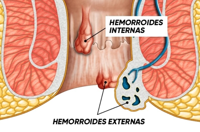 hemorroides_cirugía general y digestiva_HospitenRoca_San Agustín_Vecindario_3
