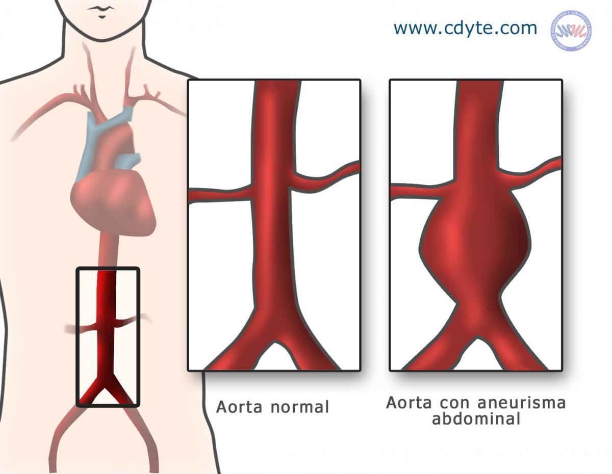 Tratamiento endovascular del Aneurisma Abdominal de Aorta